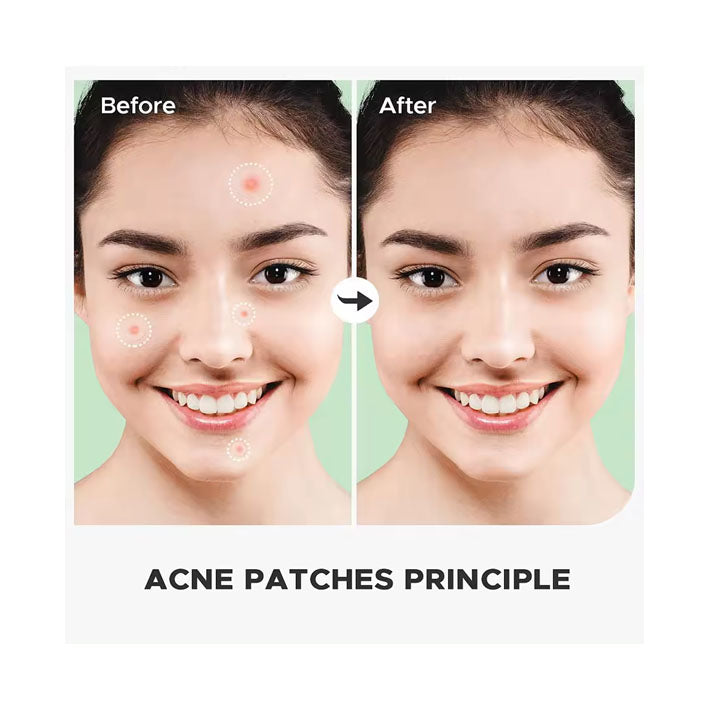 Acne Pimple Patch - MyKady